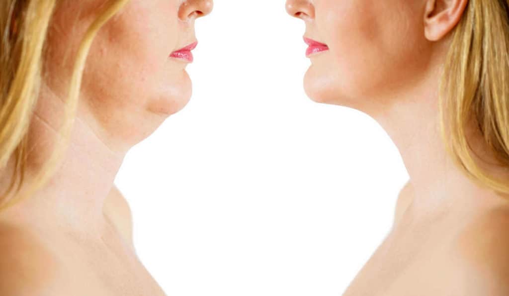 Double Chin treatment before and after results