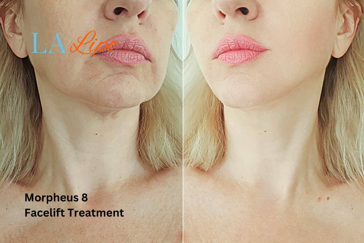 Turn back time with Morpheus8 Treatment