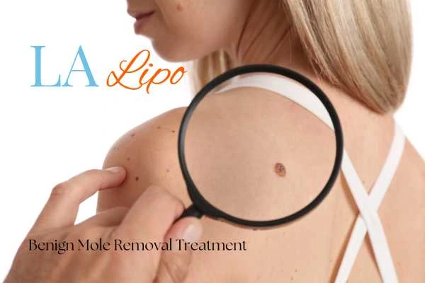Why getting moles removed can boost your confidence!