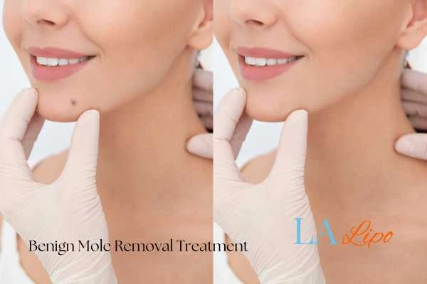 Woman's before and after results of being moles removal treatment