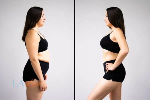 image of woman before and after results of LA-EMS Body Sculpting to help treat Diastasis recti