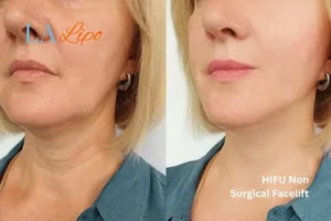 hi-fu for wrinkles before and after results