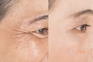 Before and after results of woman - HI-fu wrinkles reduction treatment