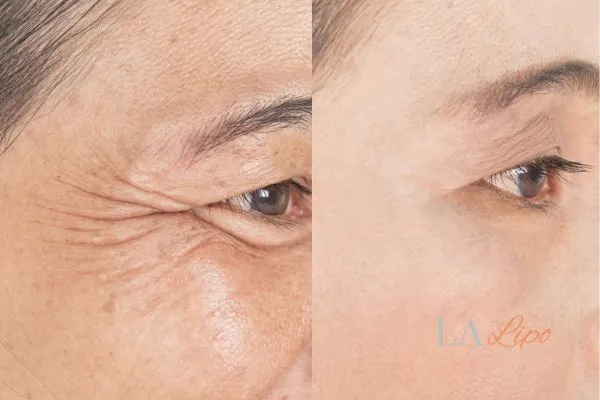 Before and after results of woman - HI-fu wrinkles reduction treatment