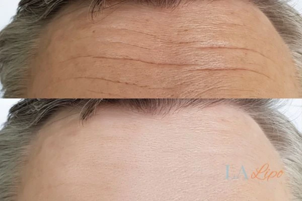 results of HIFU on mans forehead to help reduce lines and wrinkles