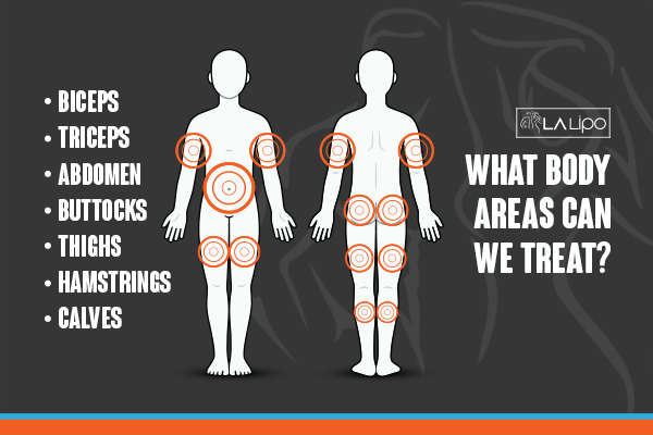 Graphic to show areas you can have LA-EMS Body Sculpting treatment.
