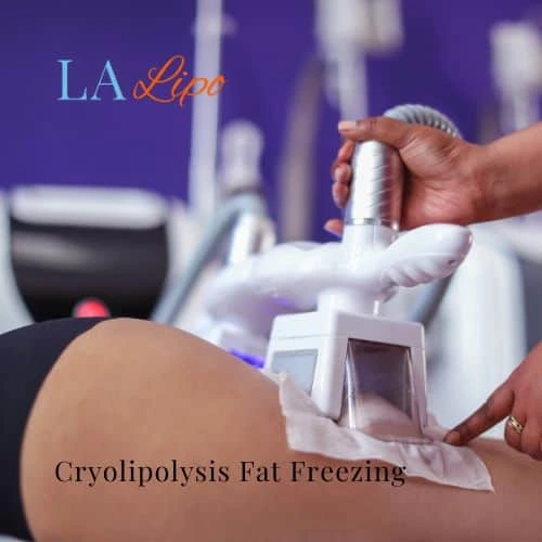 fat freezing - Cryolipolysis