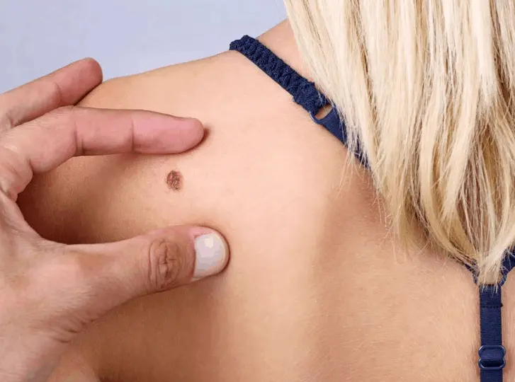 woman having mole removal consultation before treatment.