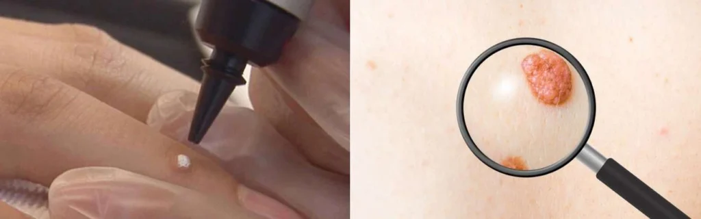 Person getting moles removed with cryopen