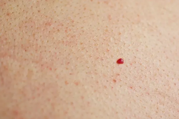 close up of a cherry angioma