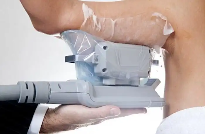 Picture of fat freezing on the upper arms.