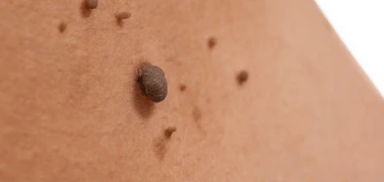 image of a skin tag