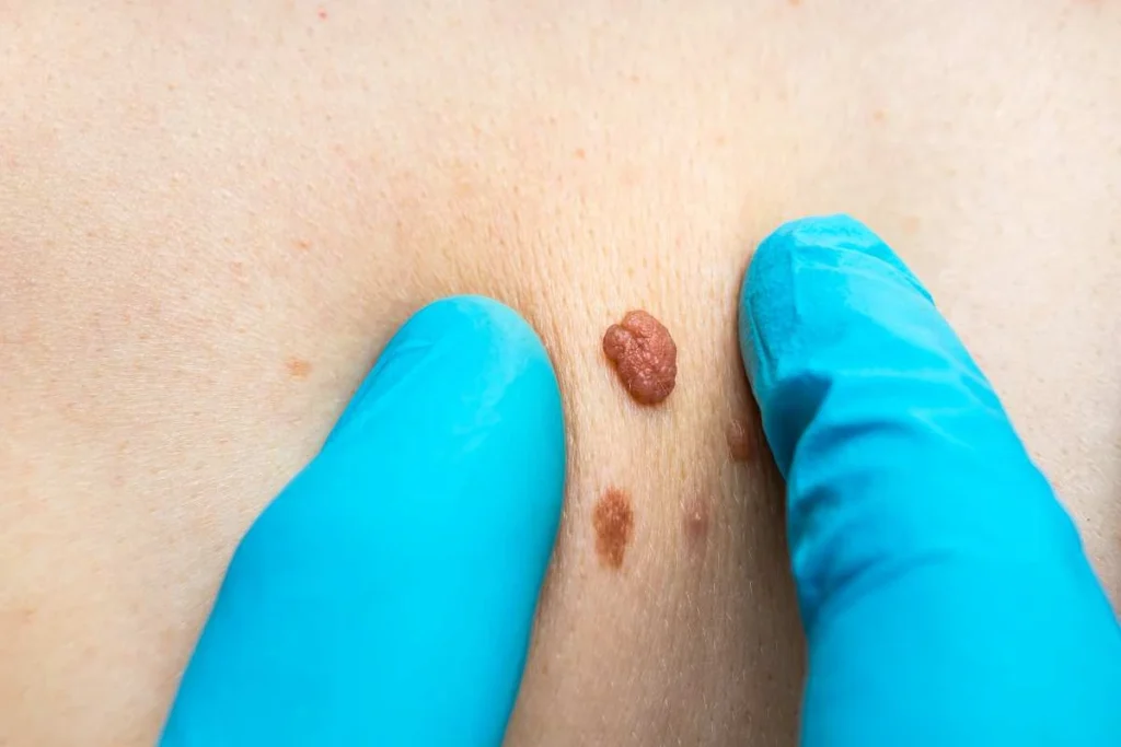 Consultant examining a skin tag