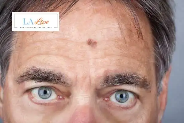 Solar Lentigo Removal image of man with mark on his forehead