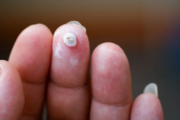wart on person finger - cryotherapy to treat from LA LIPO