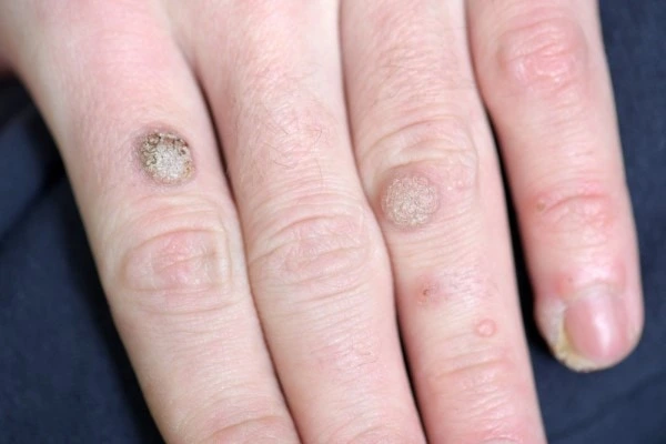 photo of warts on person hand - see wart removal from LA LIPO