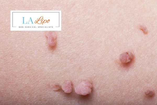 Does cryopen skin tag removal hurt? Find out now call our team today!