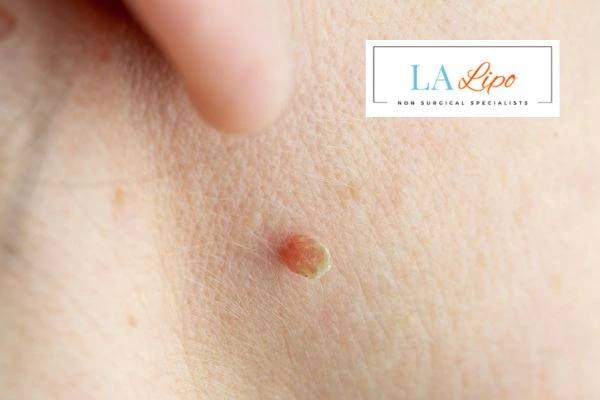 Book skin tag removal today speak to our team now!