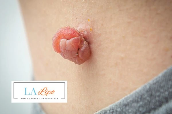 Interested in skin tag removal ? Concerned about the pain? Find out more today!
