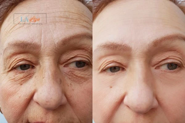 The powerful benefits of Morpheus8 Treatment - Call Our team today!