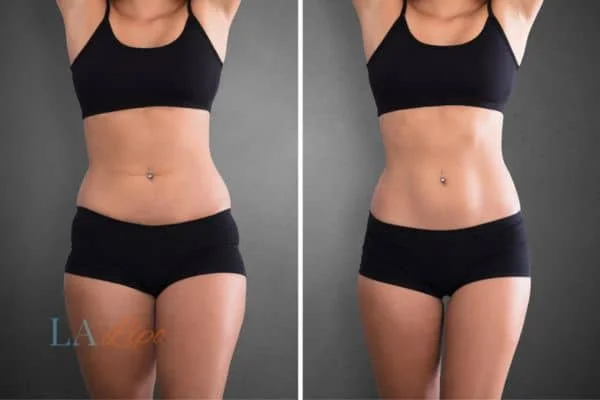 before and after results of non-surgical treatment to help a woman's body image and mental health