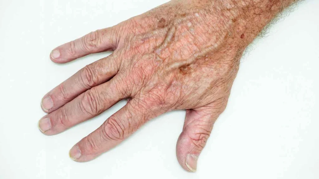 Male hand showing age spot
