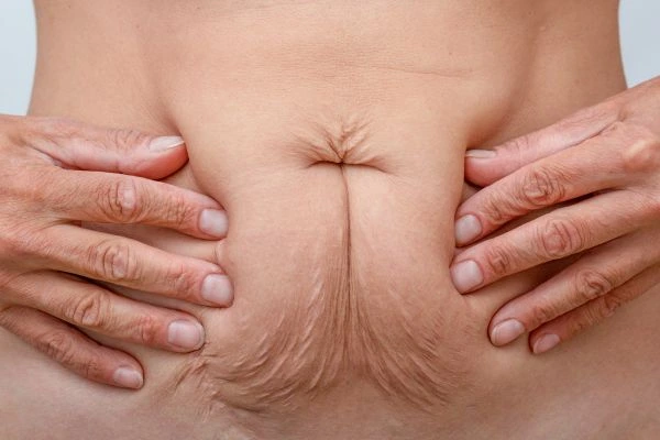 Image of a woman's stomach with loose skin - example of skin tightening options