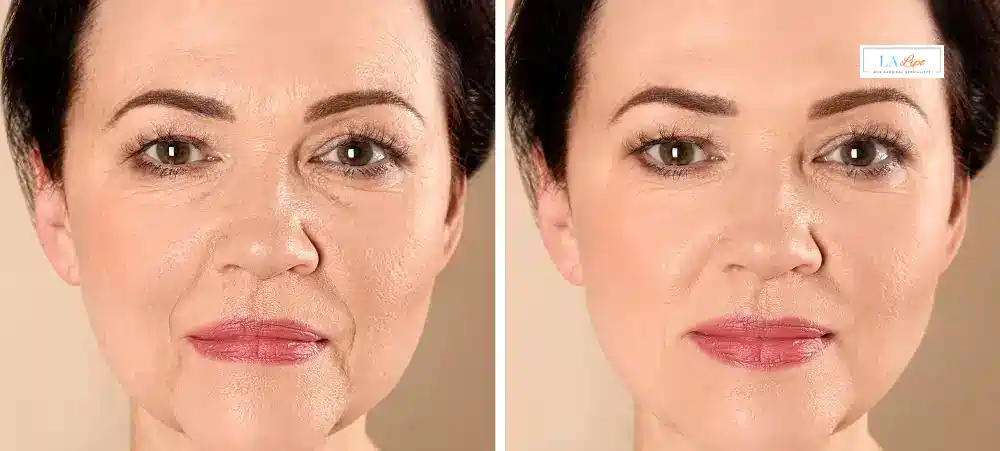 How Long Does It Take to See Results and How Long Do They Last ?