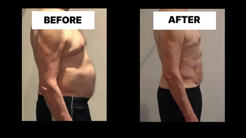 What Symptoms Can Diastasis Recti Cause in Men? Weak Core, Back Pain and Poor Posture